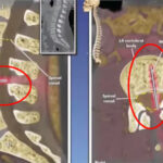 Epidural anestezi