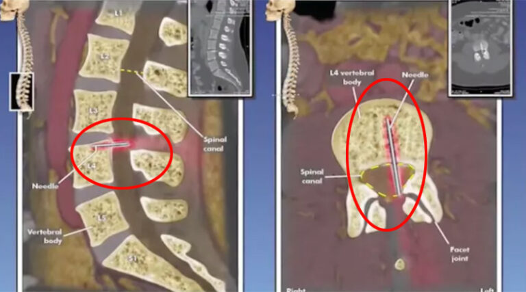 Epidural anestezi