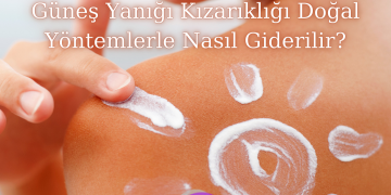 güneş yanığı kızarıklığı